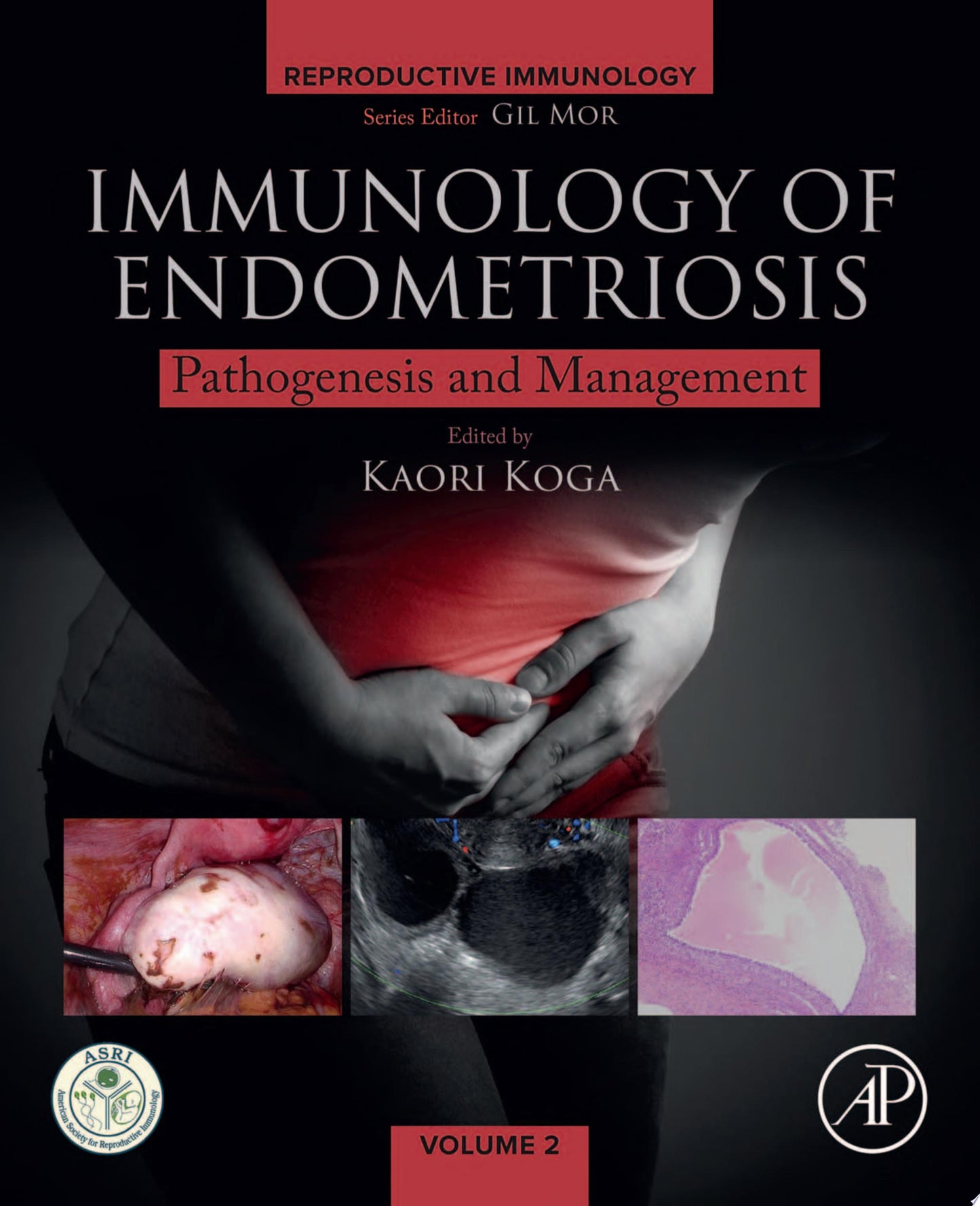 Immunology of Endometriosis: Pathogenesis and Management