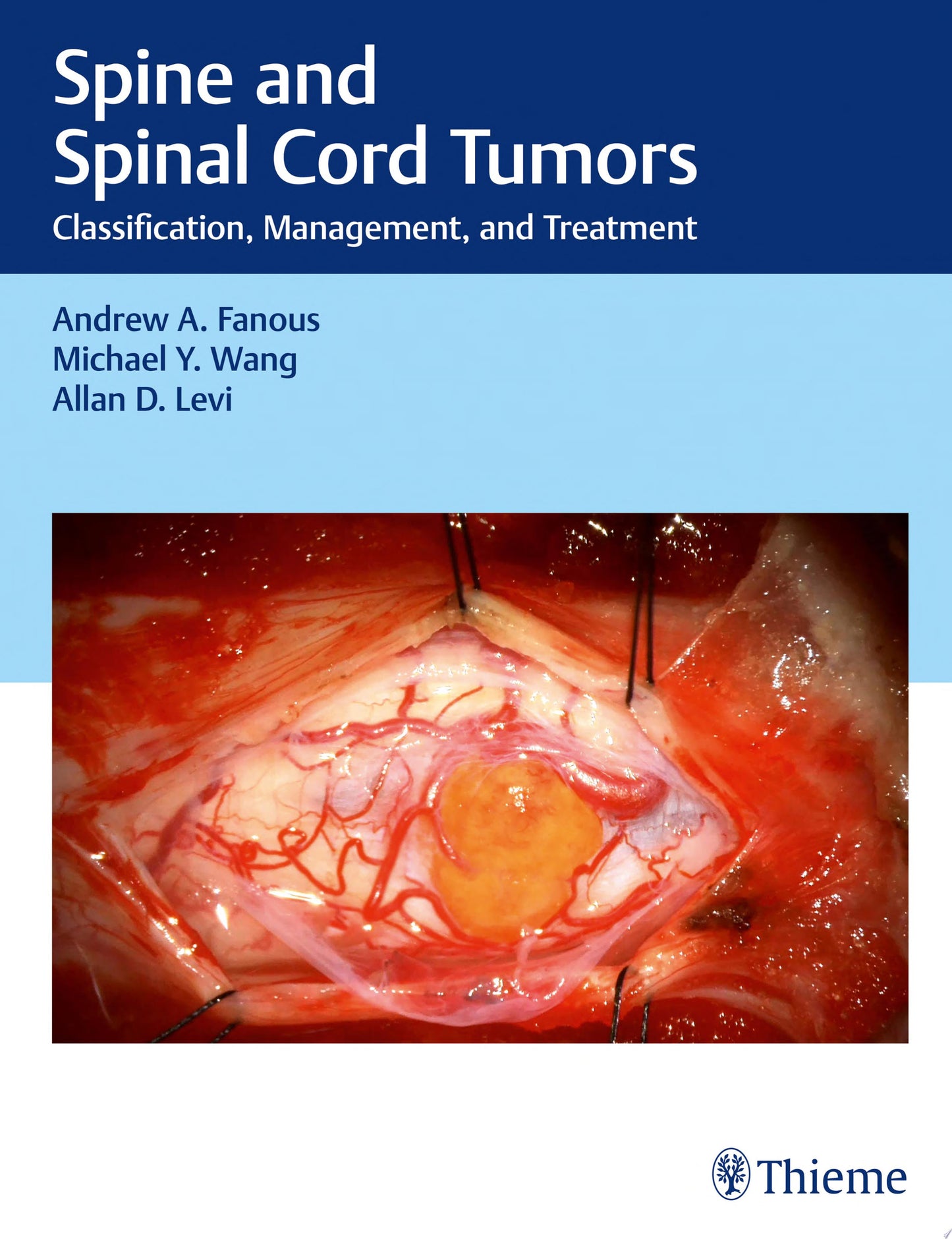 Spine and Spinal Cord Tumors: Classification, Management, and Treatment
